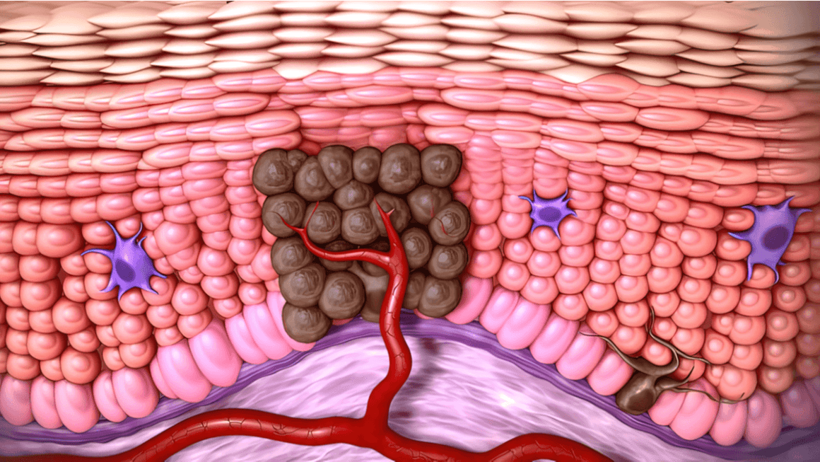 Totul despre Carcinomul Bazocelular și Carcinomul Scuamocelular