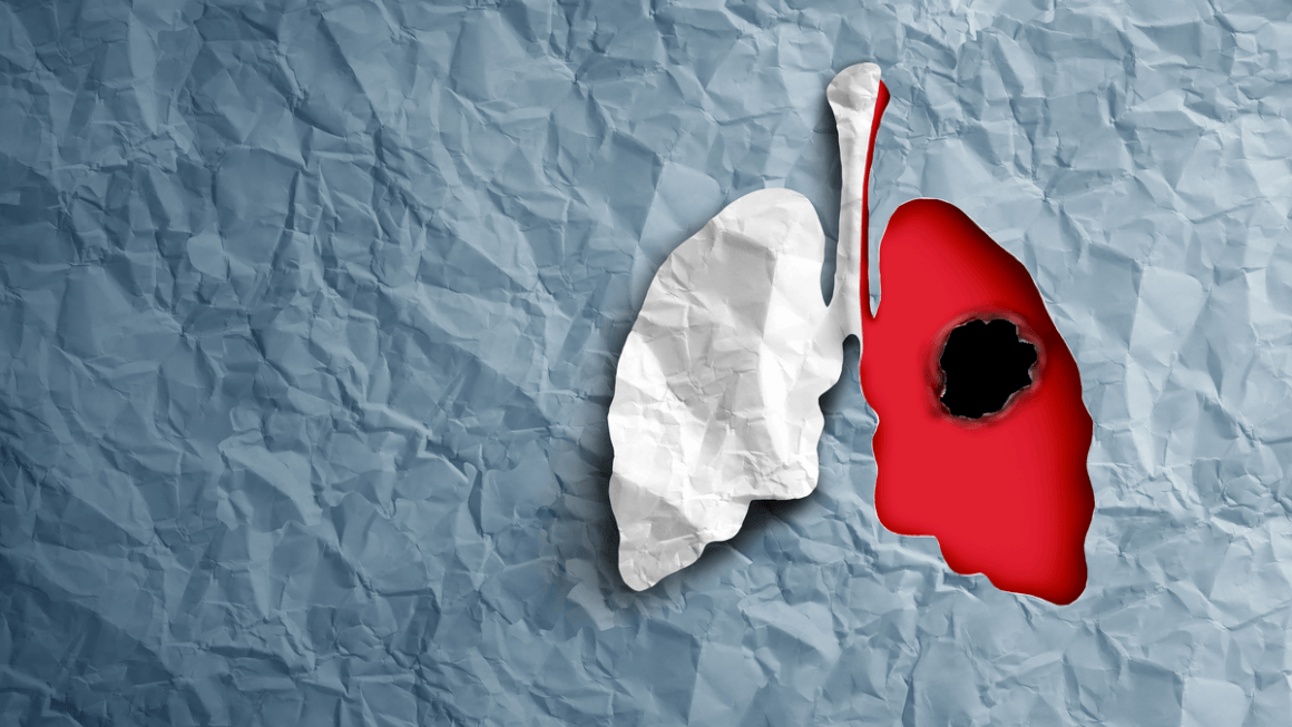 Terapia cancerului pulmonar avansat fără celule mici, schimbare de paradigmă?