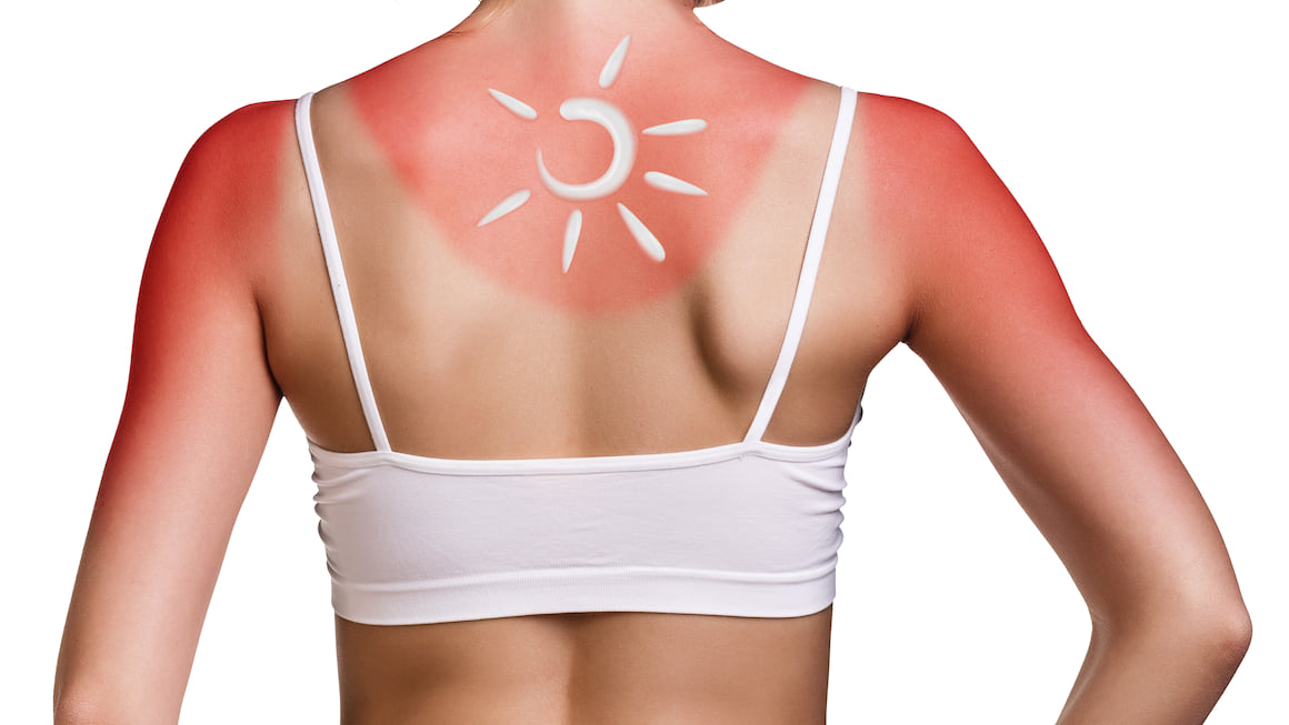 Arsurile solare: cauze, simptome si tratament