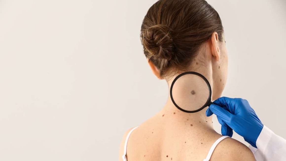 Melanomul malign familial: cauze si factori de risc