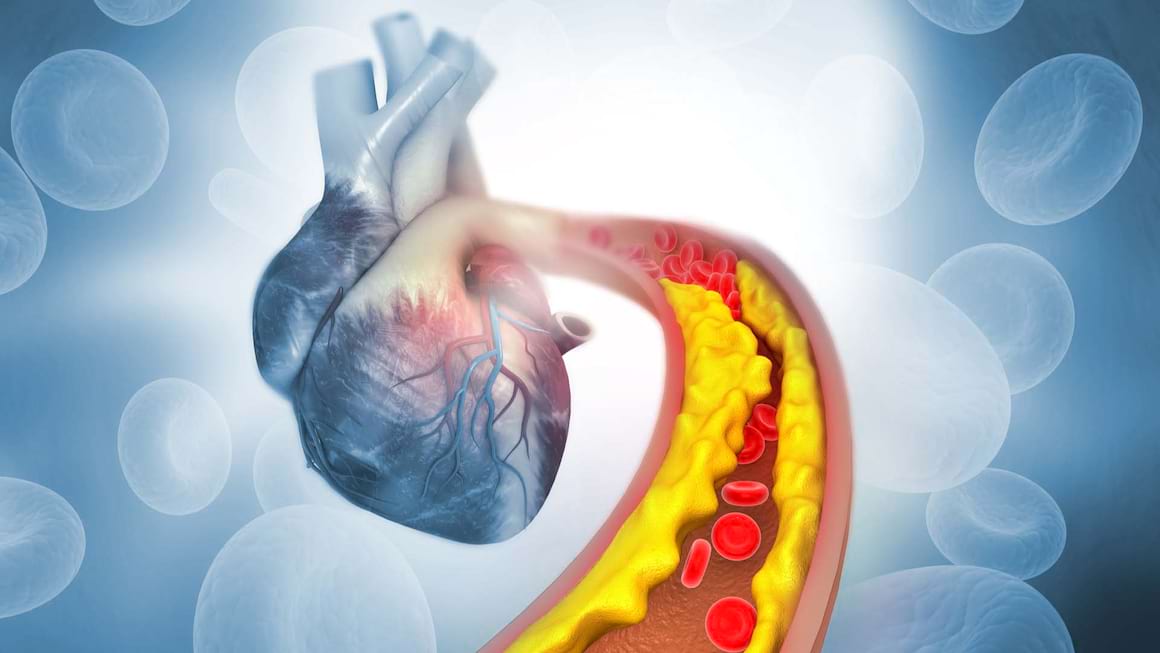 Ateroscleroza: cauze, simptome, tratament