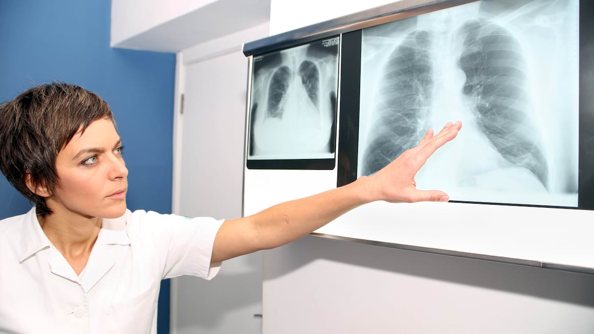 Embolie pulmonara - ce asociere exista cand vorbim despre colesterol?