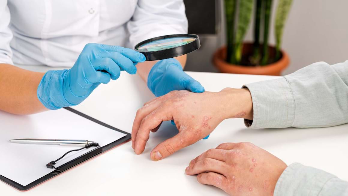 Psoriazis: cauze, simptome si tratament
