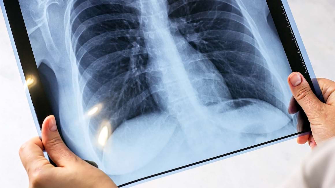 Tuberculoza (TBC) - Ce este, Simptome si Tratament