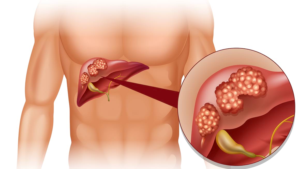 Ficatul – prevenirea si tratarea afectiunilor hepatice in medicina chineza