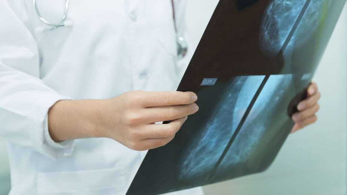 Carcinomul apocrin mamar: caracteristici si diferente fata de alte forme de cancer de san