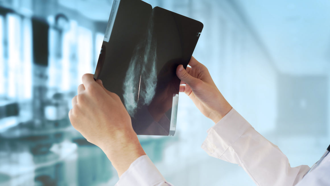 Cancerul mamar triplu negativ