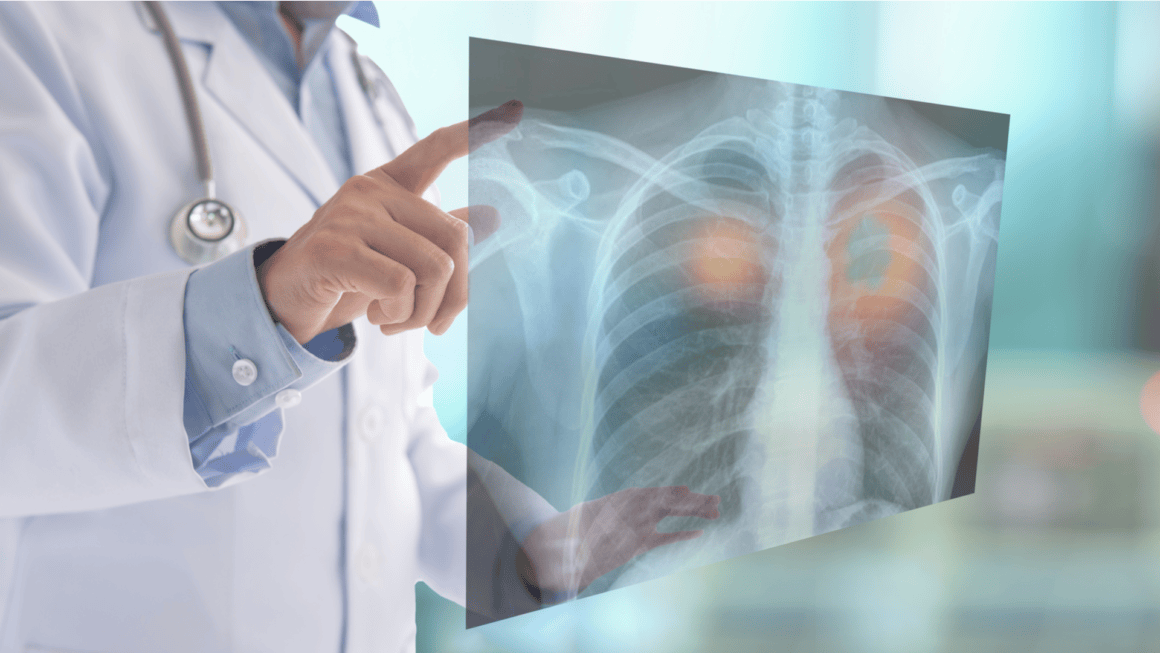 Tratamentul cancerului pulmonar