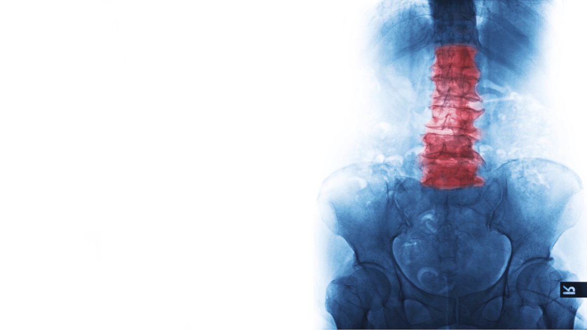 Durerea lombară cauzată de spondilită: diagnosticare și tratament