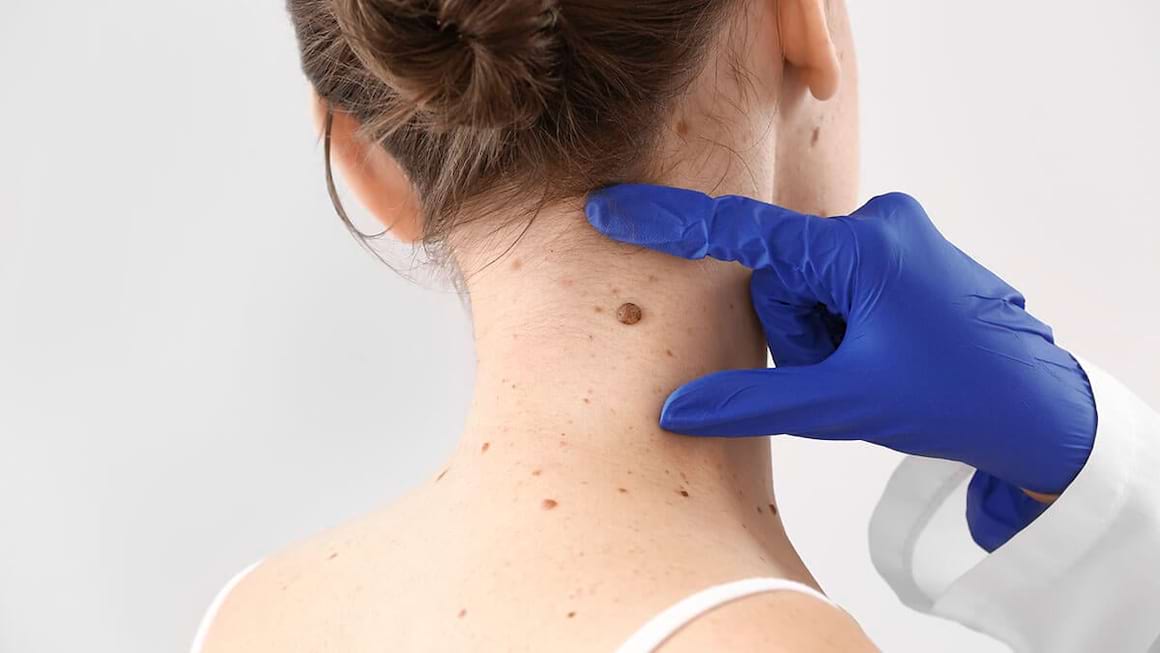 Ai rude cu cancer de piele? Testele genetice îți pot estima riscul