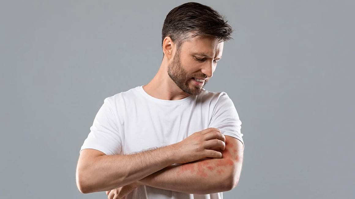 Alimentația în dermatita atopică: ce este recomandat și ce nu?