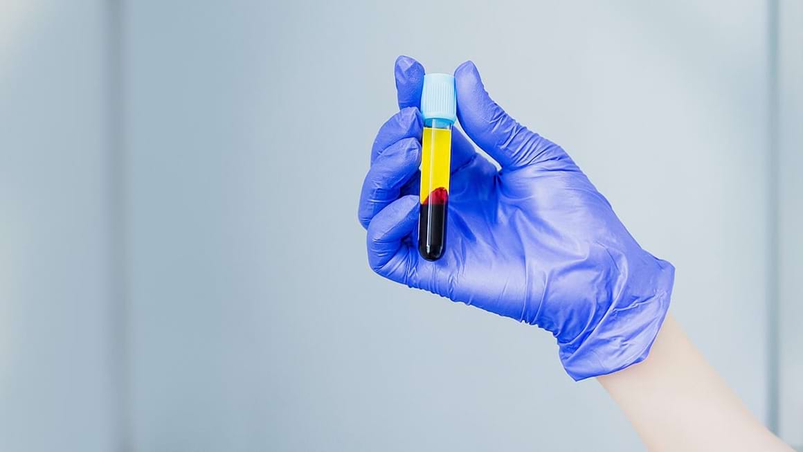 Este plasma bogată în trombocite de ajutor în artroză?