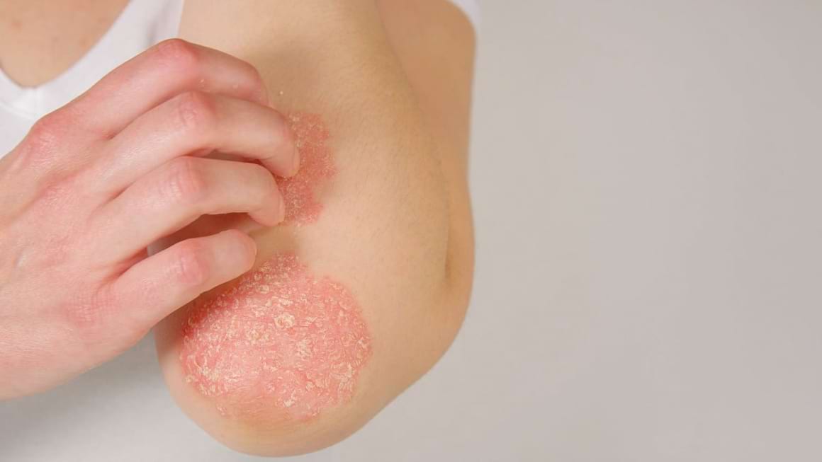 Psoriazisul in sarcina: simptome & tratament