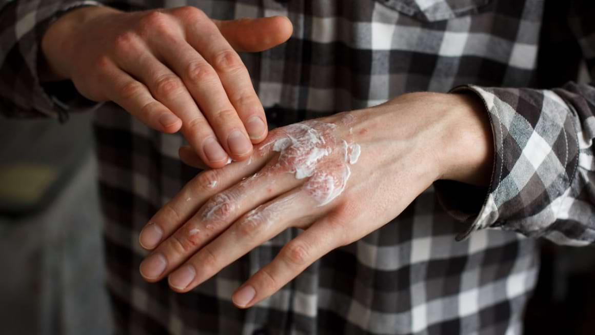 Tratamentul pentru psoriazis: de ce uneori nu mai funcționează?