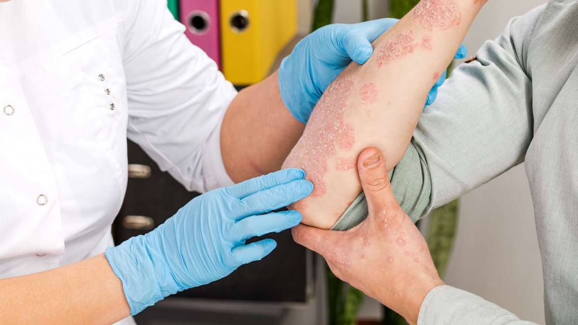 Psoriazisul: care sunt cauzele, cum se manifesta boala si cum se trateaza?