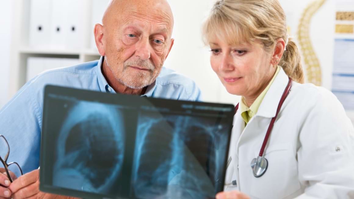 Cauzele cancerului pulmonar