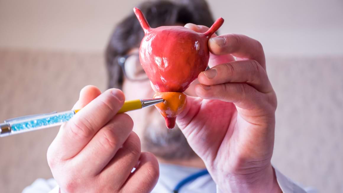Complicatii ale adenomului de prostata: obstructie urinara si pietre la vezica
