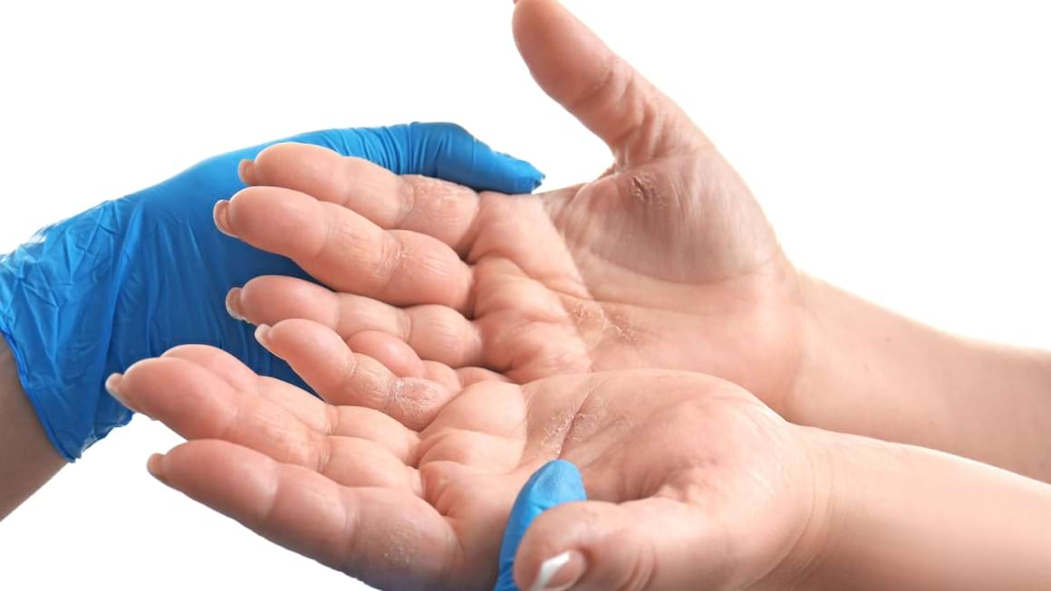 Dermatita de contact: Cauze - Simptome - Tratament