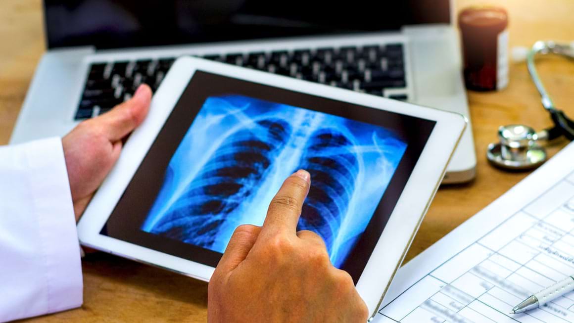Evolutia si tratamentul cancerului pulmonar