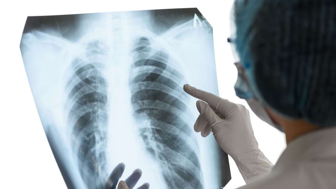 Pneumotoraxul: cauze, simptome & tratament