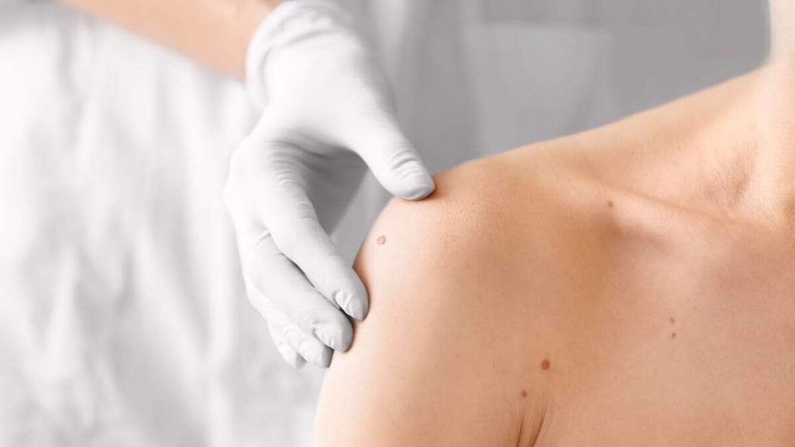 Ameliorarea prognosticului în melanomul malign