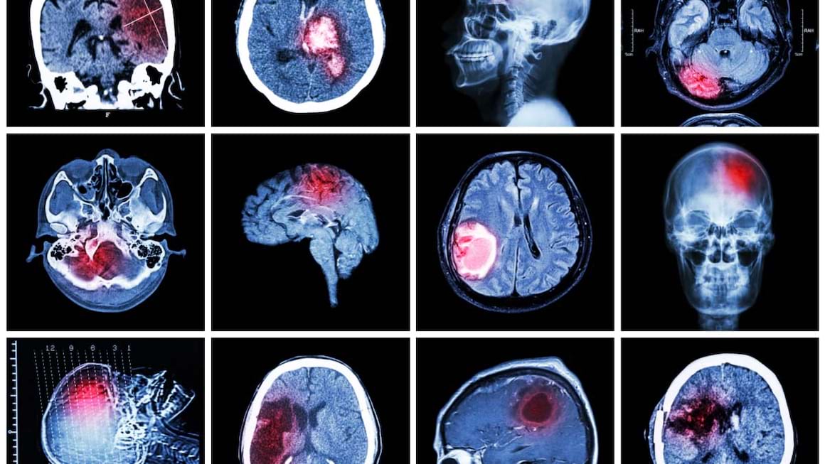 Diagnosticul imagistic la pacientii cu AVC