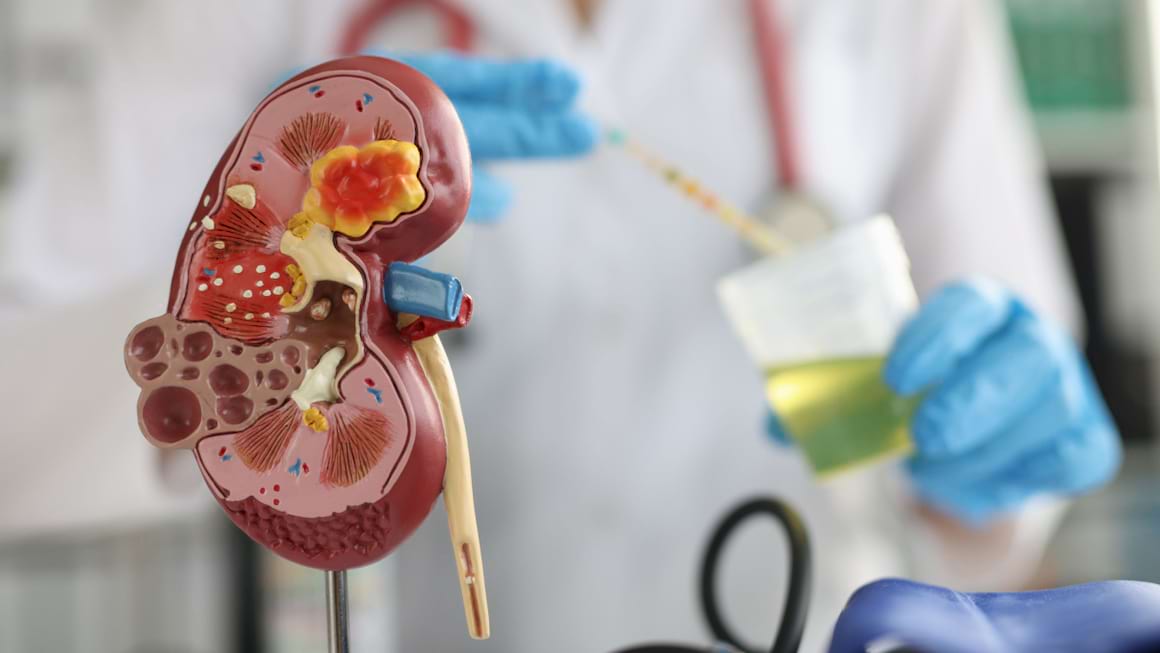 Hematuria (urinare cu sange): cauze si solutii