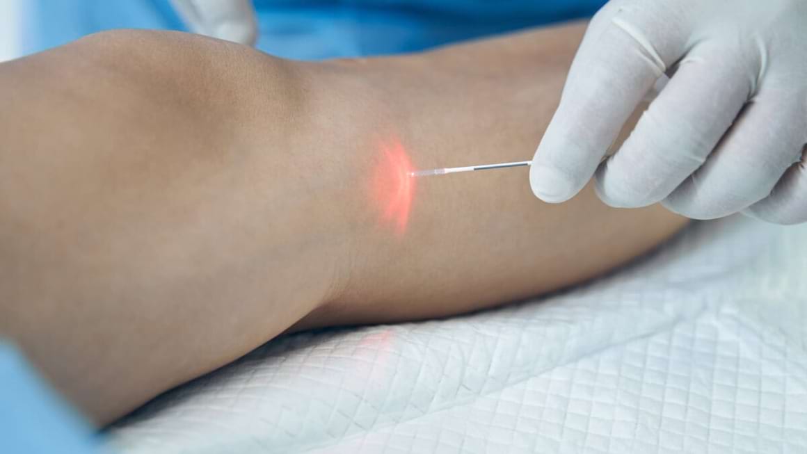 Laser simplu și laser endovenos: ce beneficii are fiecare procedura pentru tratarea varicelor
