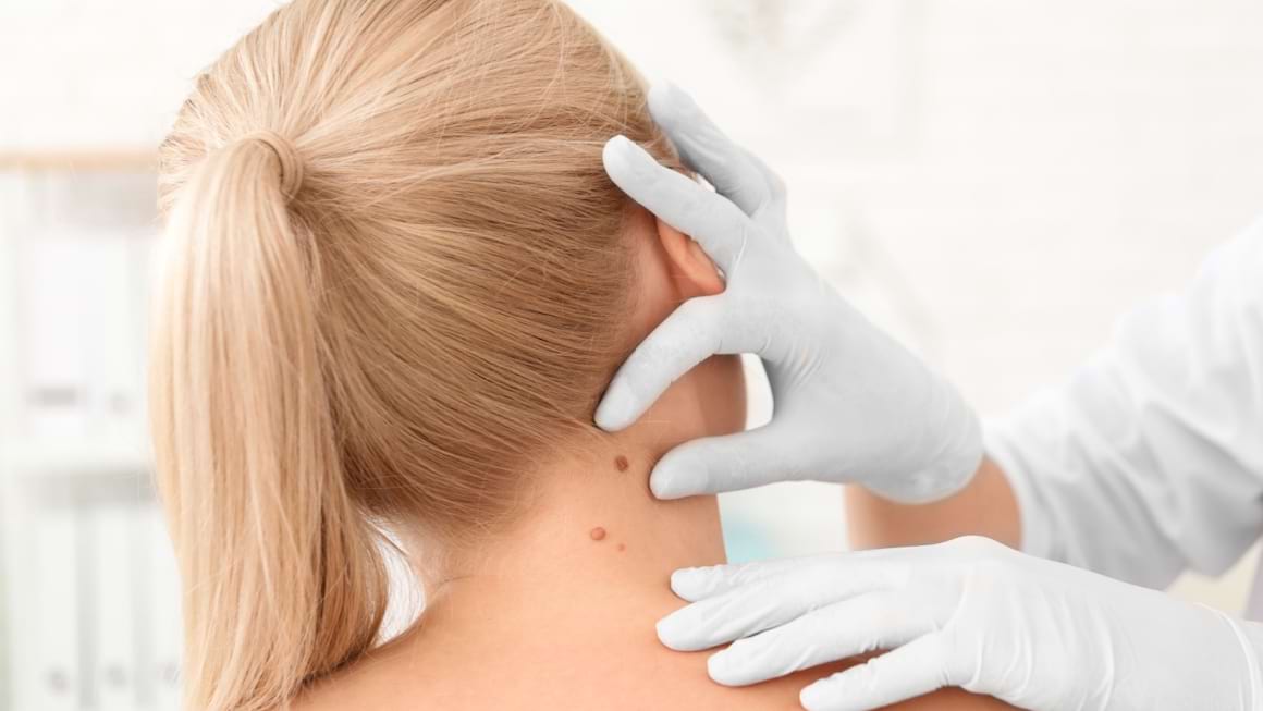 Pe ce zone ale pielii se poate dezvolta melanomul?