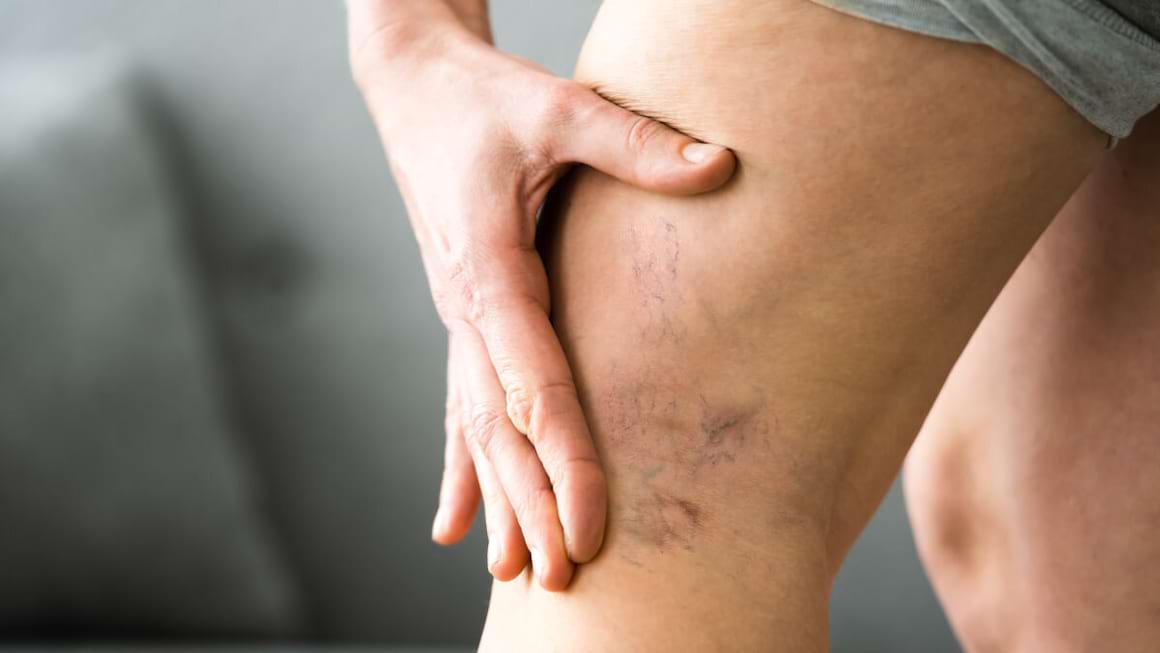 Terapia compresiva in boala venoasa cronica