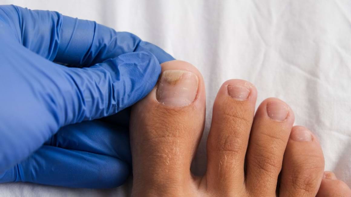 Micoza unghiei: diagnosticare, tratament si prevenire