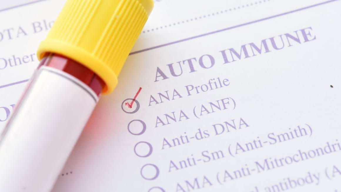 Criterii de diagnostic serologic la pacientii cu lupus