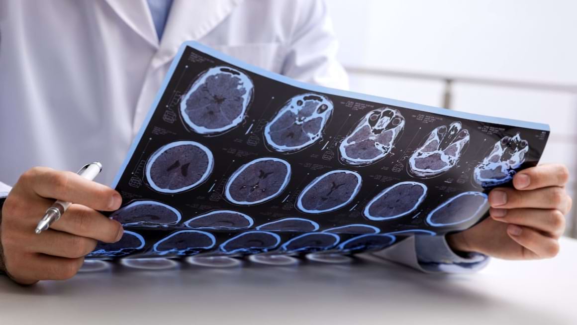 Scleroza concentrica (Balo): cauze, simptome, tratament