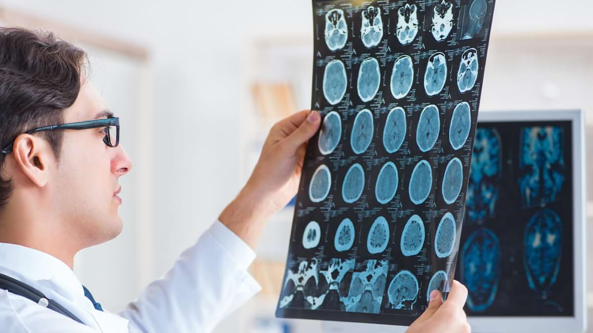 Accidentul vascular cerebral tranzitoriu