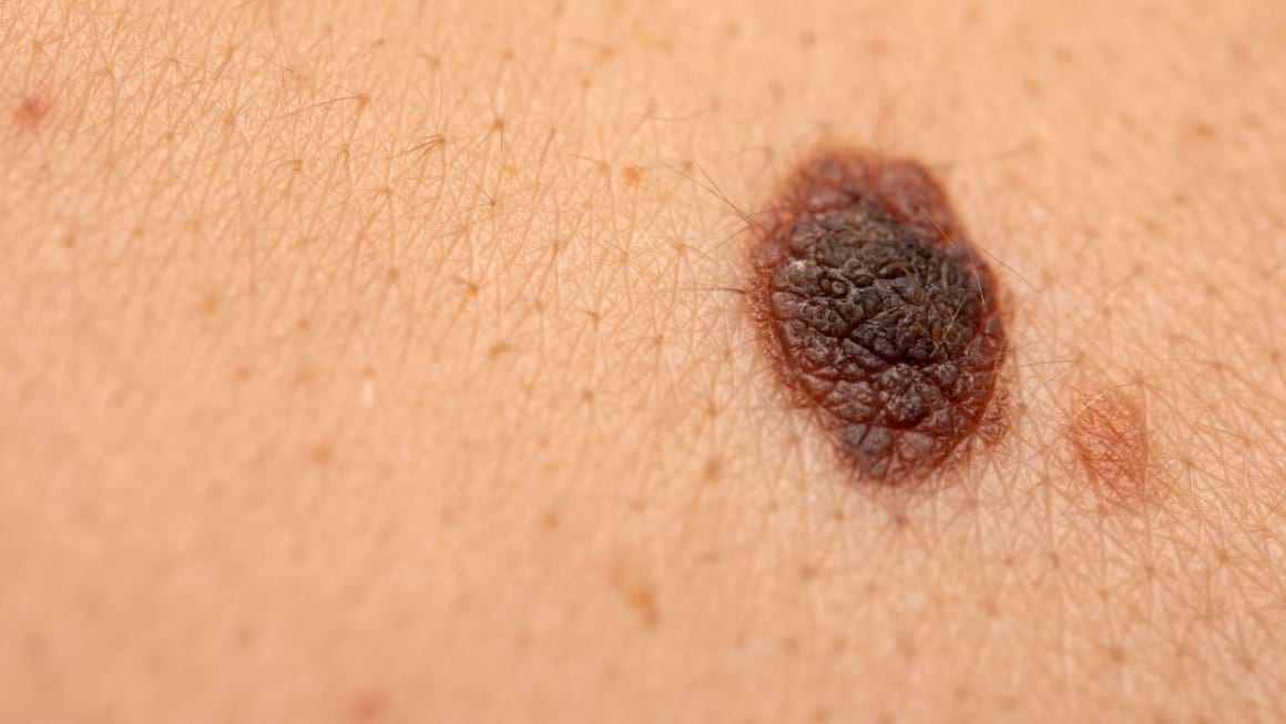 Melanomul malign rezecabil - un nou standard terapeutic?