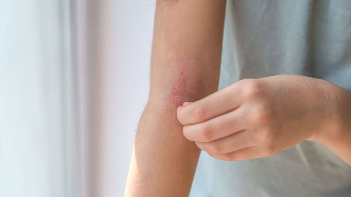 Cu dermatita atopica la plaja