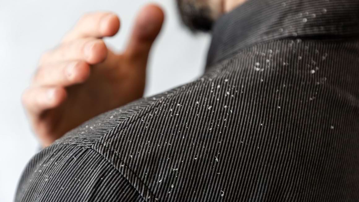 Dermatita seboreica – ce este si cum o tratam?