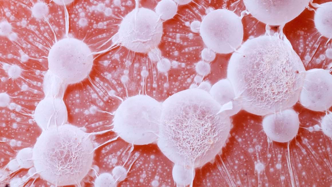 Metastazele cerebrale - ce sunt, simptome și tratament