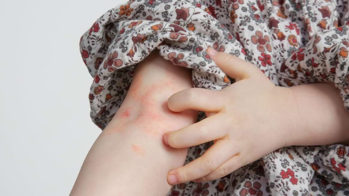 La ce trebuie sa ai grija in vacanta, daca ai un copil cu psoriazis?