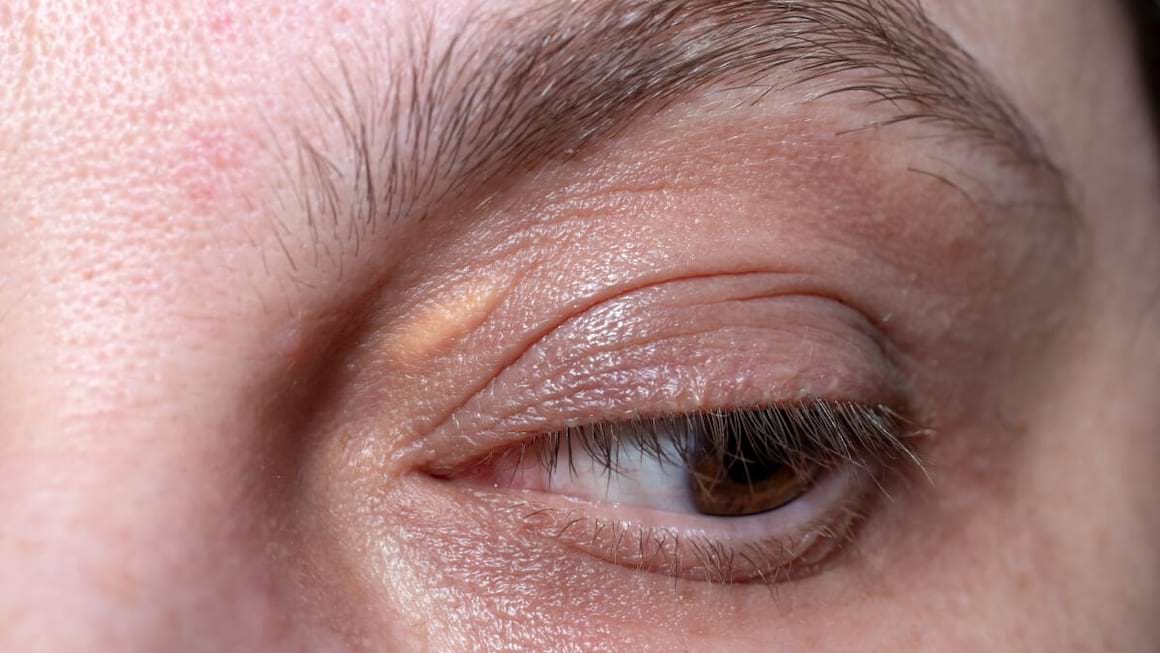 Xantoamele: cauze, diagnostic si tratament