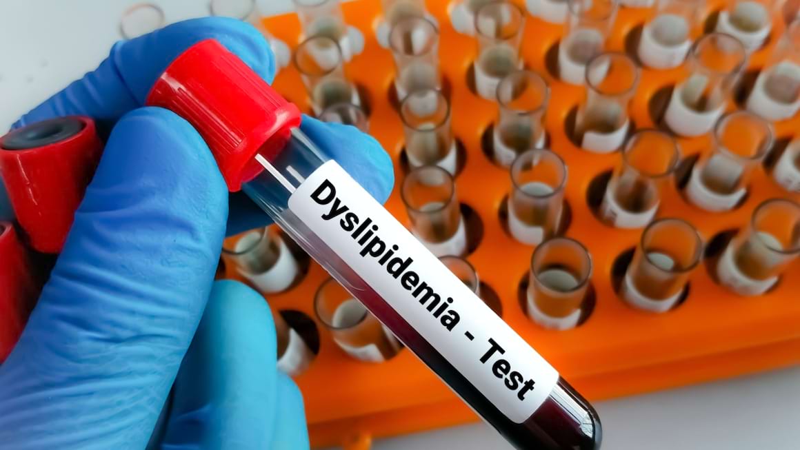 Simptome si diagnostic in dislipidemie