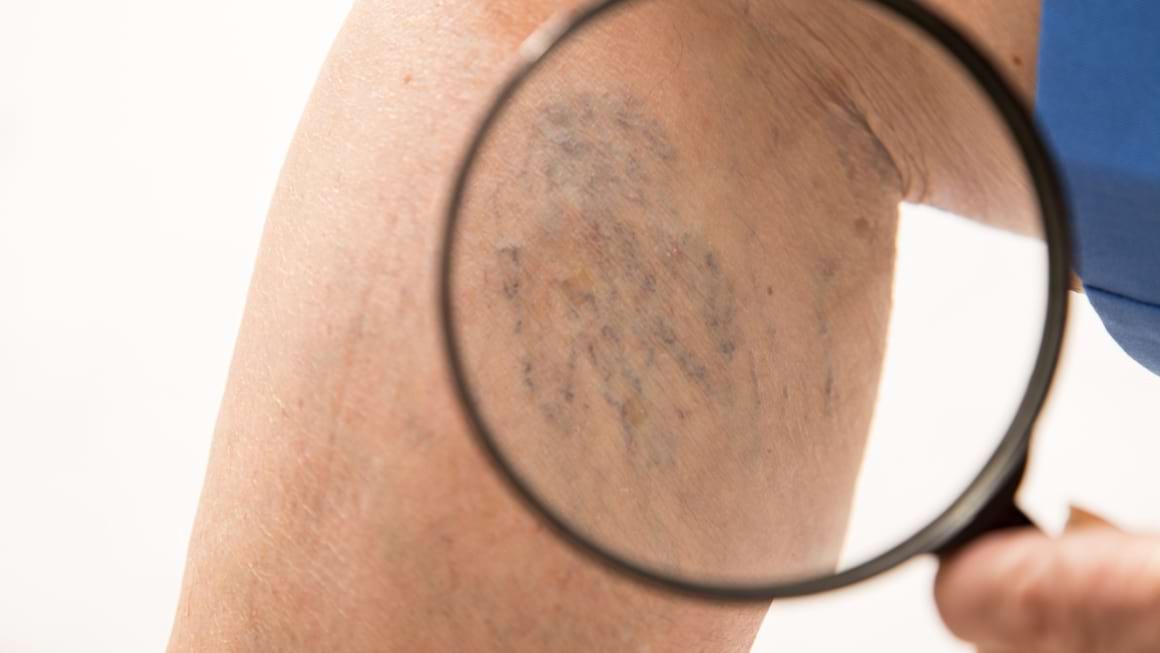 7 lucruri pe care cei cu insuficienta venoasa cronica le inteleg cel mai bine