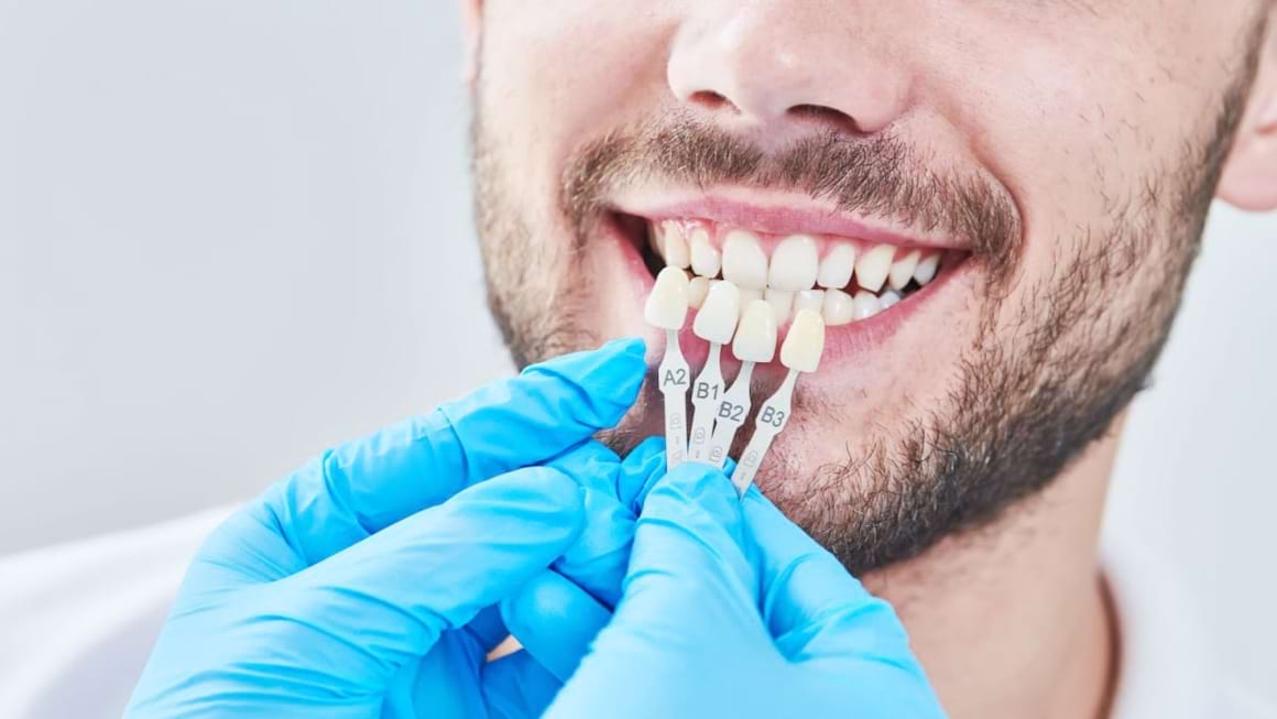 Restaurările dentare: de ce este importantă și cum se realizează alegerea culorii?