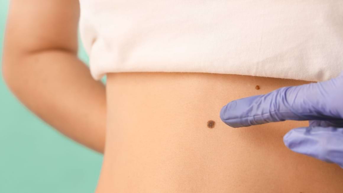 Cancerul de piele, prevenire și recomandări date de terapeuții chinezi