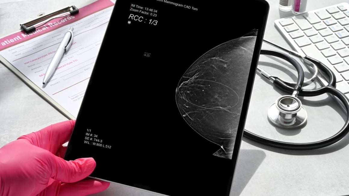 Tumorile in cancerul mamar au dimensiuni mai mici la momentul diagnosticului