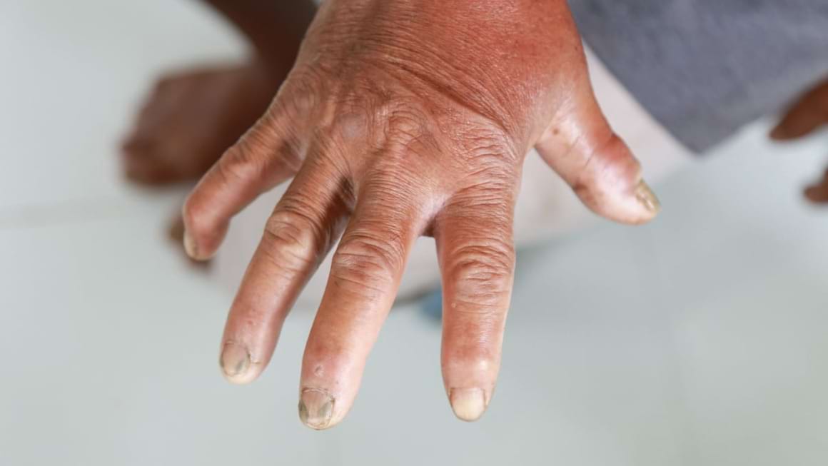 Totul despre morfee: simptome, diagnostic, tratament