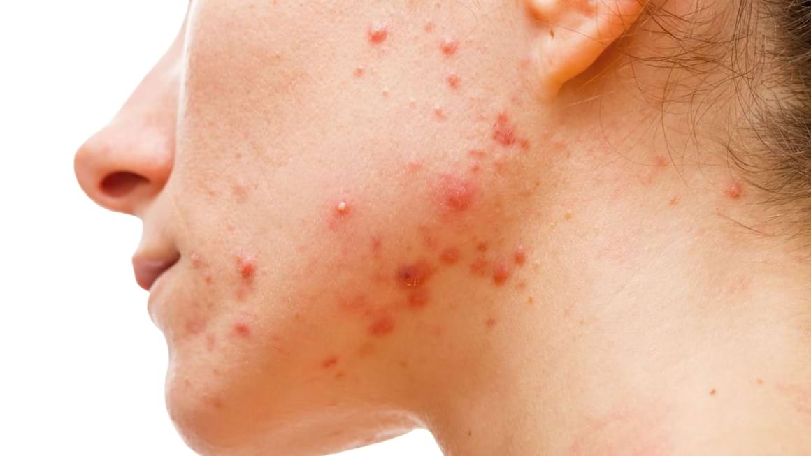 Acneea suprainfectată cu stafilococ auriu și streptococ