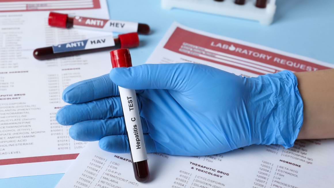 Hepatita C: genotiparea virusului hepatitic C