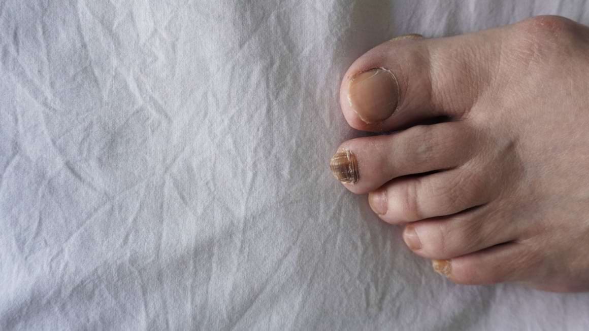 Melanomul lentiginos acral