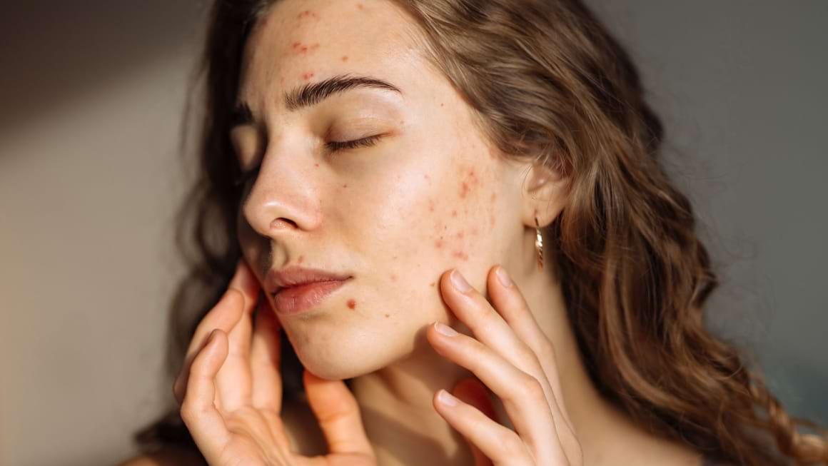 Dezechilibrul dintre bacteriile de pe piele ar putea declansa acneea